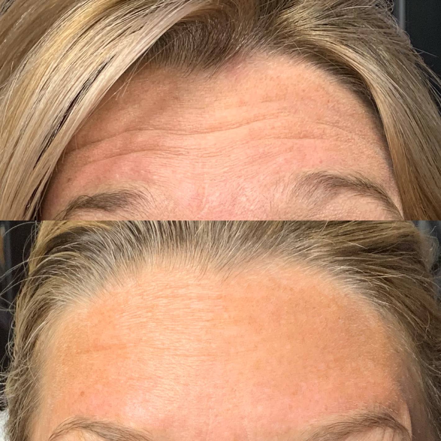 botox forehead before and after